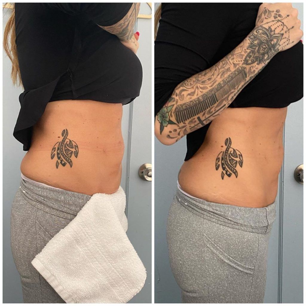 Before and after of a woman's waist with a tattoo — Minneapolis, MN — InstaSculpting Body Contour Center