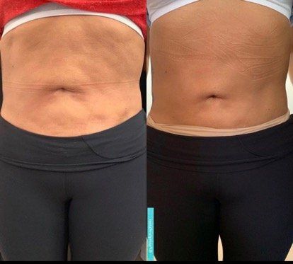 Before and after losing stomach fat — Minneapolis, MN — InstaSculpting Body Contour Center