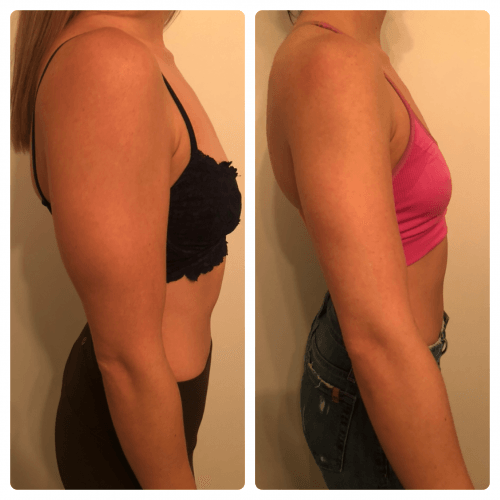 Before and after losing arm fat — Minneapolis, MN — InstaSculpting Body Contour Center