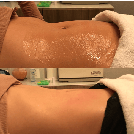 Before and after stomach contour — Minneapolis, MN — InstaSculpting Body Contour Center