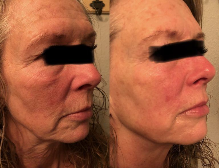 Before and after face contour — Minneapolis, MN — InstaSculpting Body Contour Center