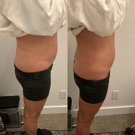 Before and after waist contour — Minneapolis, MN — InstaSculpting Body Contour Center