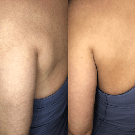 Before and after contouring of woman's back — Minneapolis, MN — InstaSculpting Body Contour Center