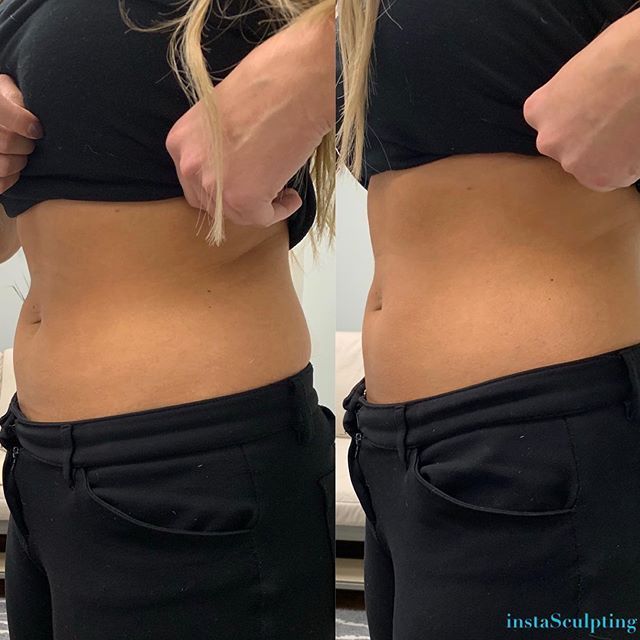 Woman having body shape after the procedure — Minneapolis, MN — InstaSculpting Body Contour Center