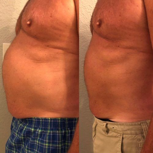 Non-surgical body fat reduction — Minneapolis, MN — InstaSculpting Body Contour Center