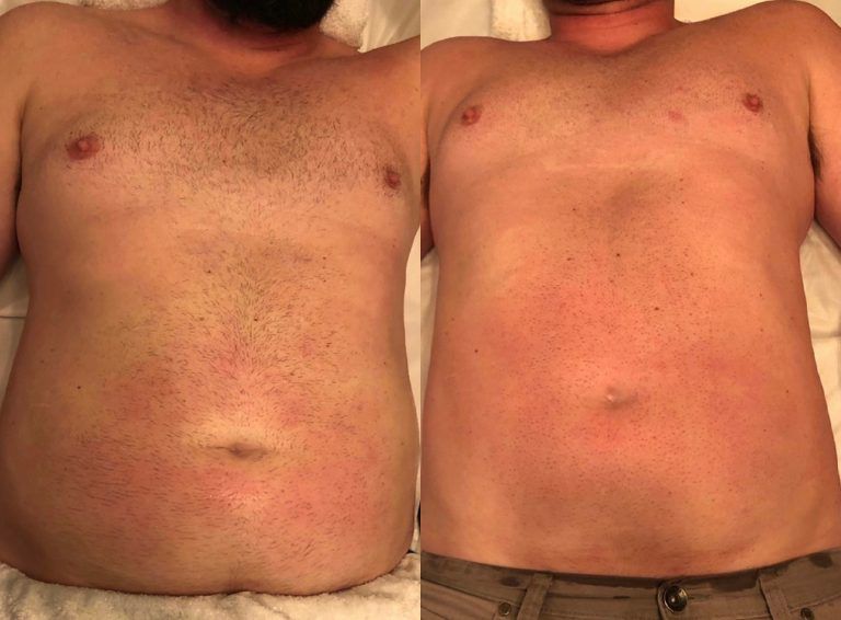 Before and after of a man's body fat reduction — Minneapolis, MN — InstaSculpting Body Contour Center