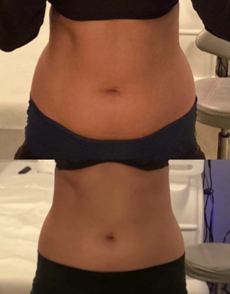 Before and after eliminating stomach fat — Minneapolis, MN — InstaSculpting Body Contour Center