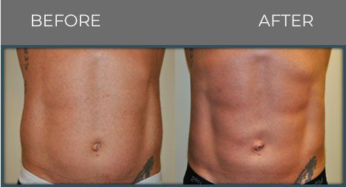 Front shot of male abdomen — Minneapolis, MN — InstaSculpting Body Contour Center