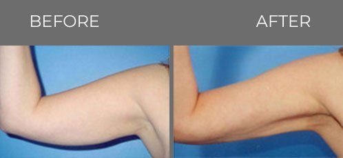 Before and after shot of right upper arm — Minneapolis, MN — InstaSculpting Body Contour Center