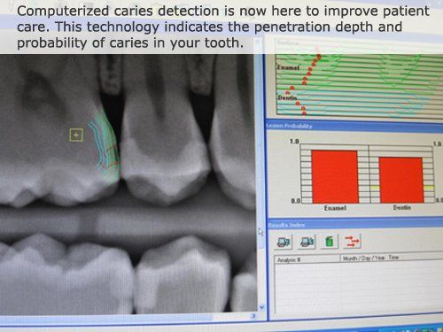 High Tech Equipment — Computerized Caries Detection in Plainville, MA