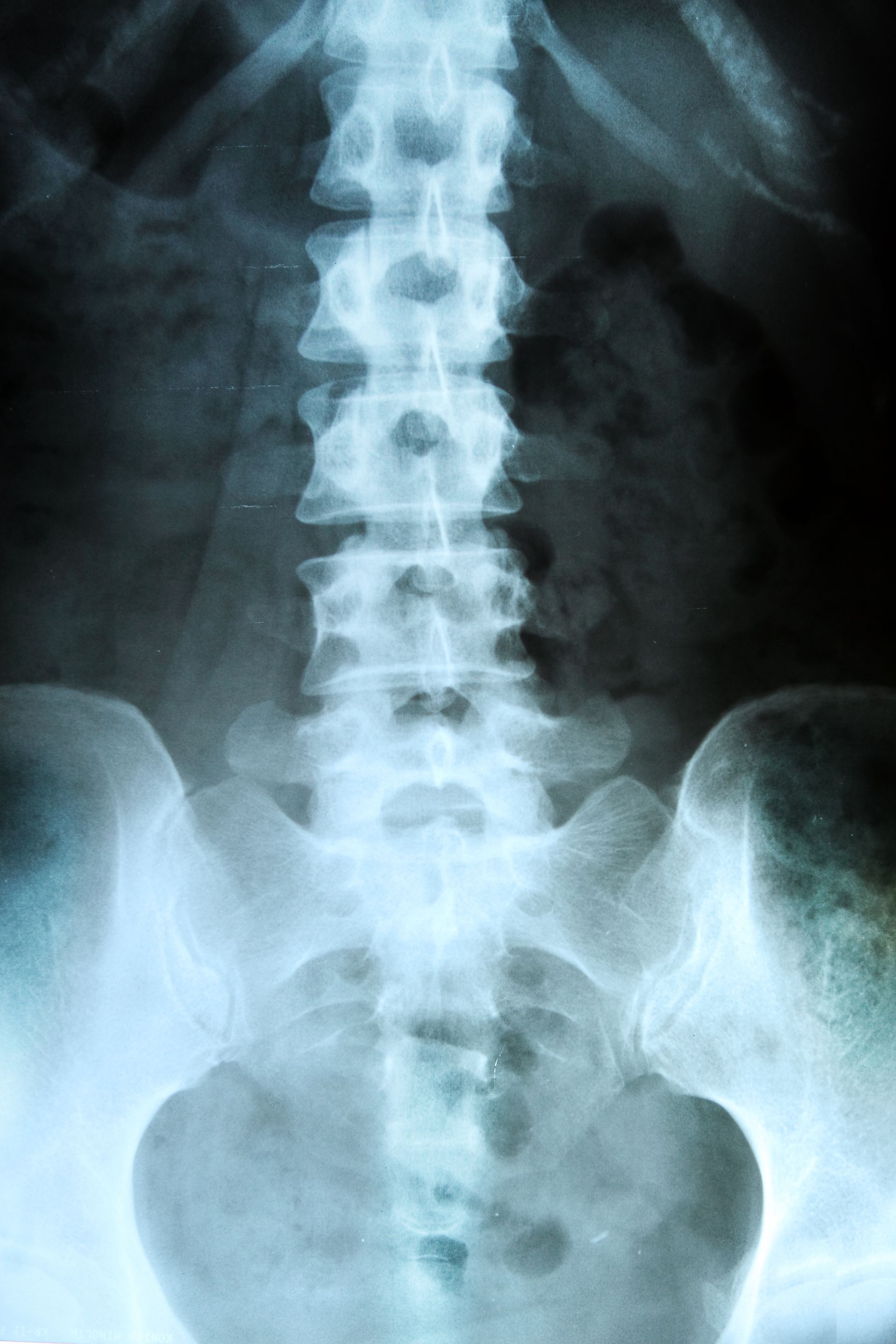 An x-ray of a person 's pelvis and hip joint.