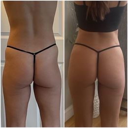 Before and after views of a person's buttocks. Left image: looser skin. Right image: firmer, more contoured.