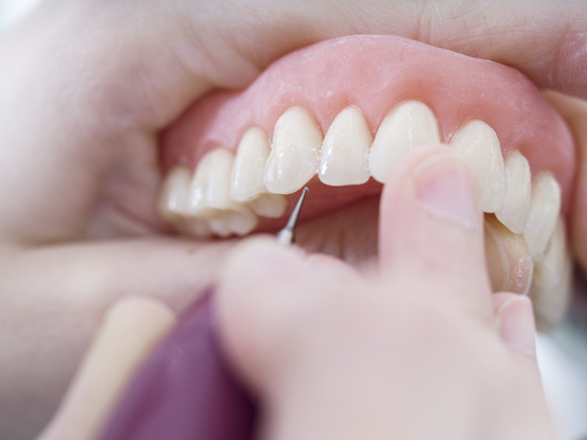 Full Dentures — Wagga Wagga, NSW — Wagga Denture Clinic