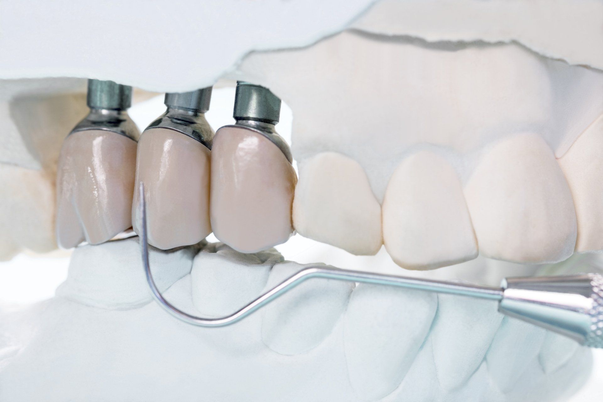 Implant Retained Dentures — Wagga Wagga, NSW — Wagga Denture Clinic