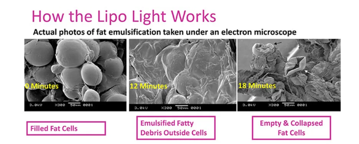 A diagram showing how MyLipo Laser Body Sculpting in St. Louis works