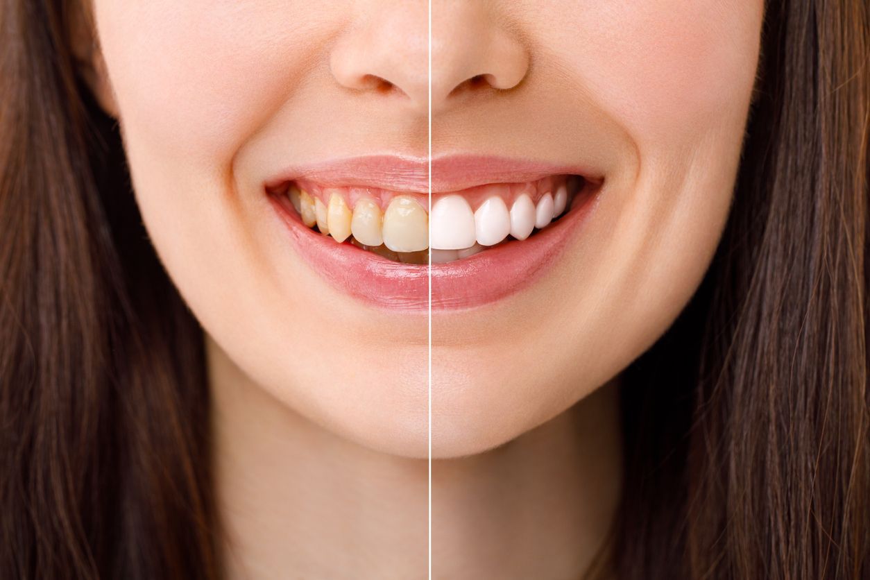 A woman is sitting in a dental chair getting her teeth examined by a dentist.