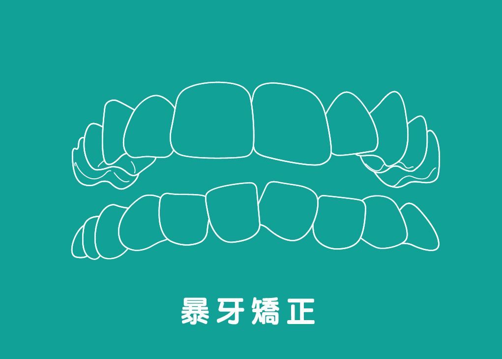 暴牙Protruded teeth