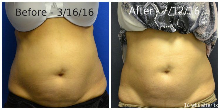 Sculptsure Fat Removal Manhasset NY