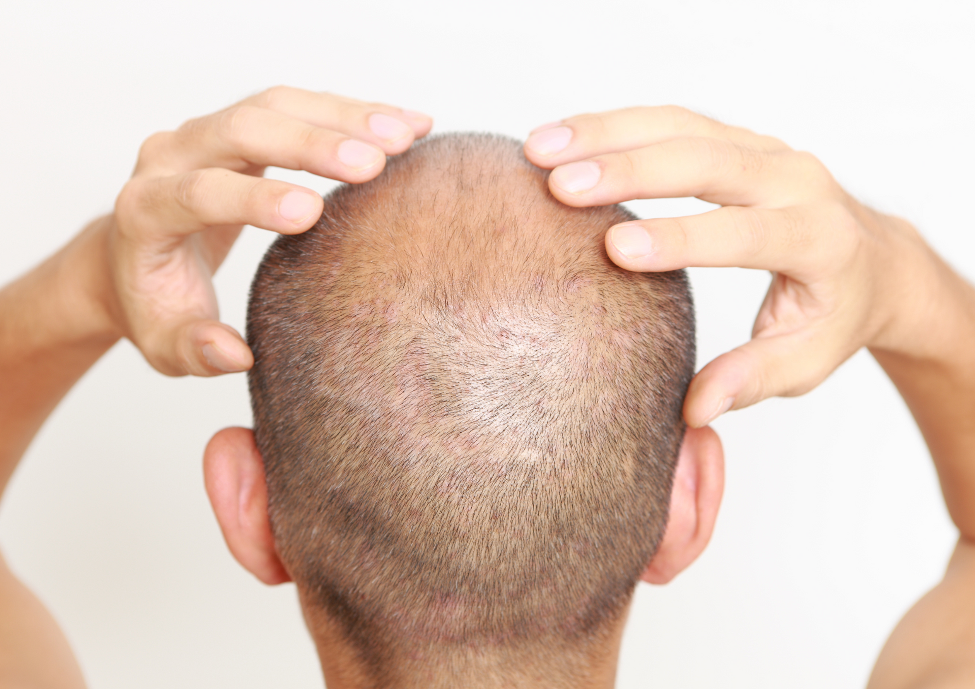 WHAT SHOULD MEN KNOW ABOUT SCALP MICROPIGMENTATION?