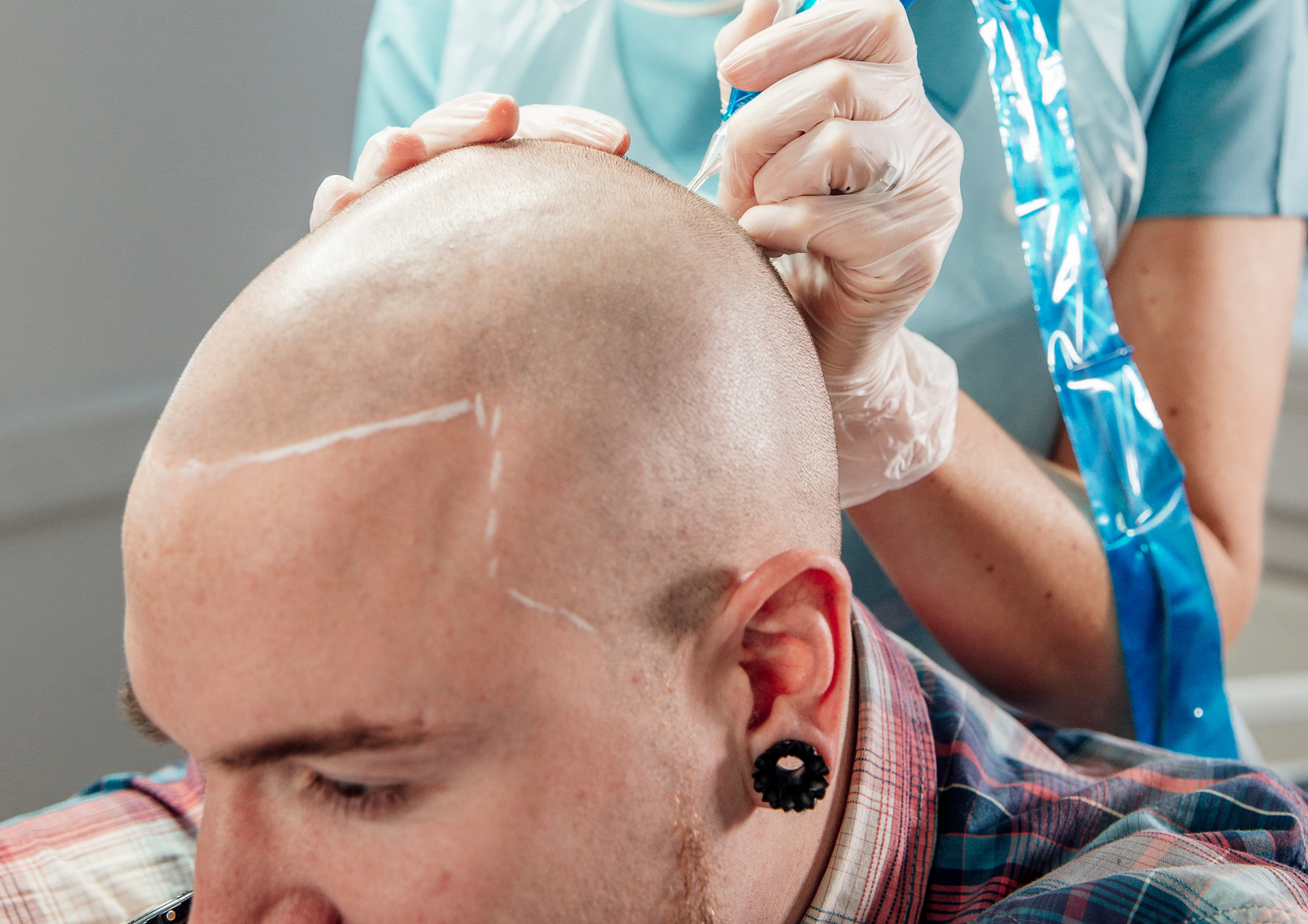 WHAT ARE THE DIFFERENT USES OF SCALP MICRO-PIGMENTATION FOR MEN?