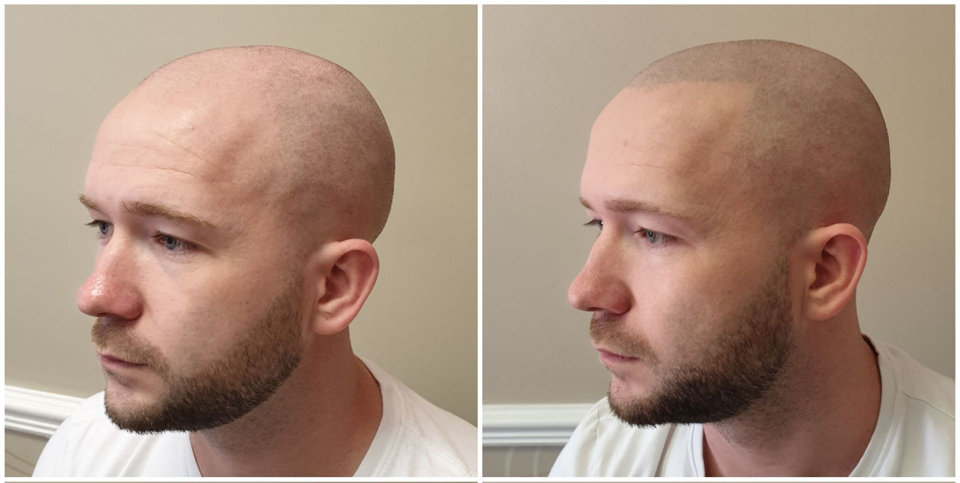 Male SMP - Restore Hairline
