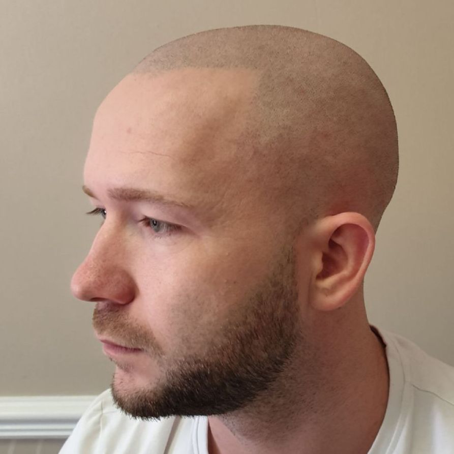 male pattern baldness SMP after