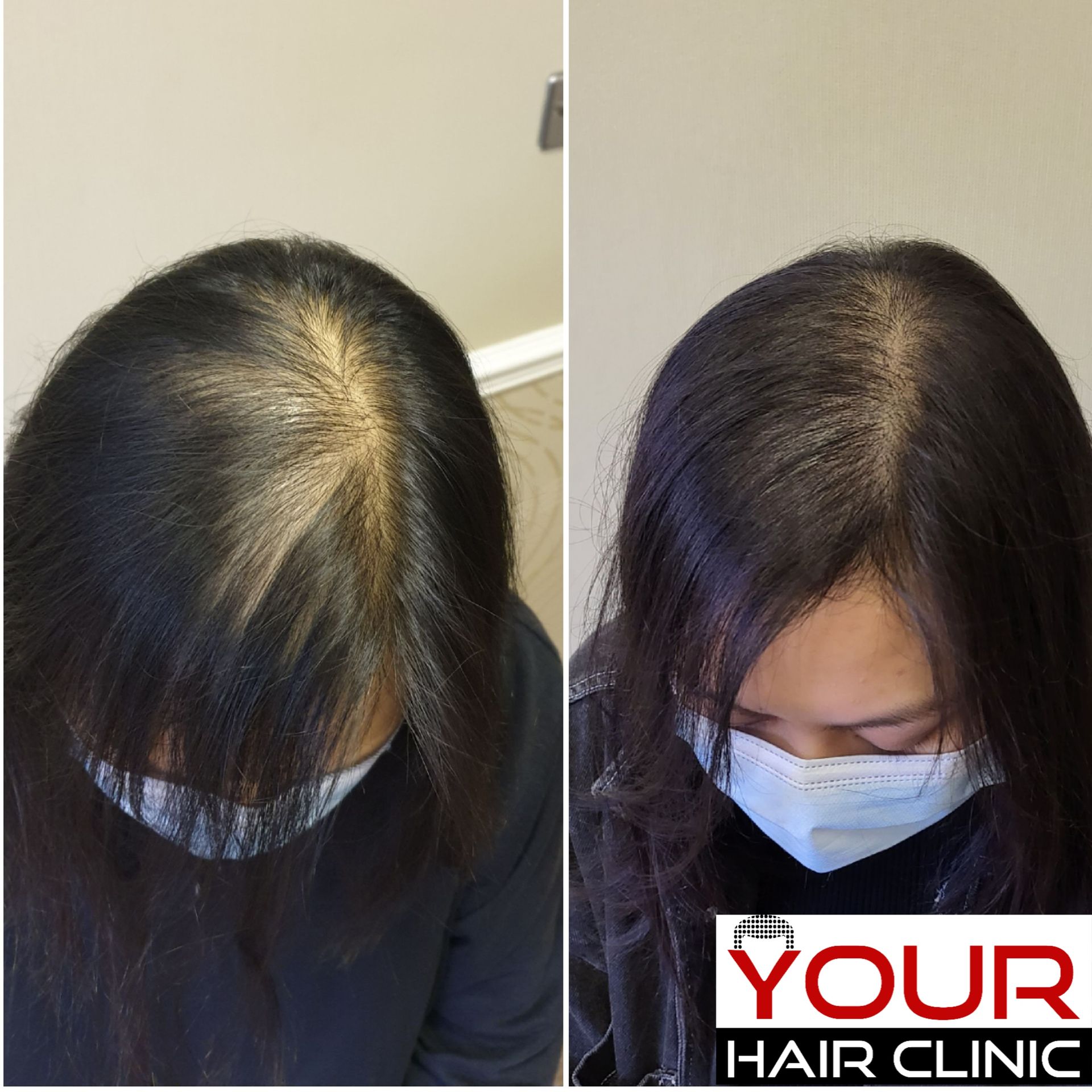 Women SMP for thinning hair