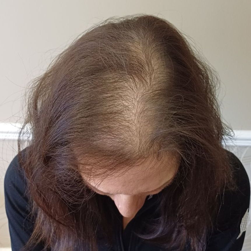 Hair thinning SMP correction before