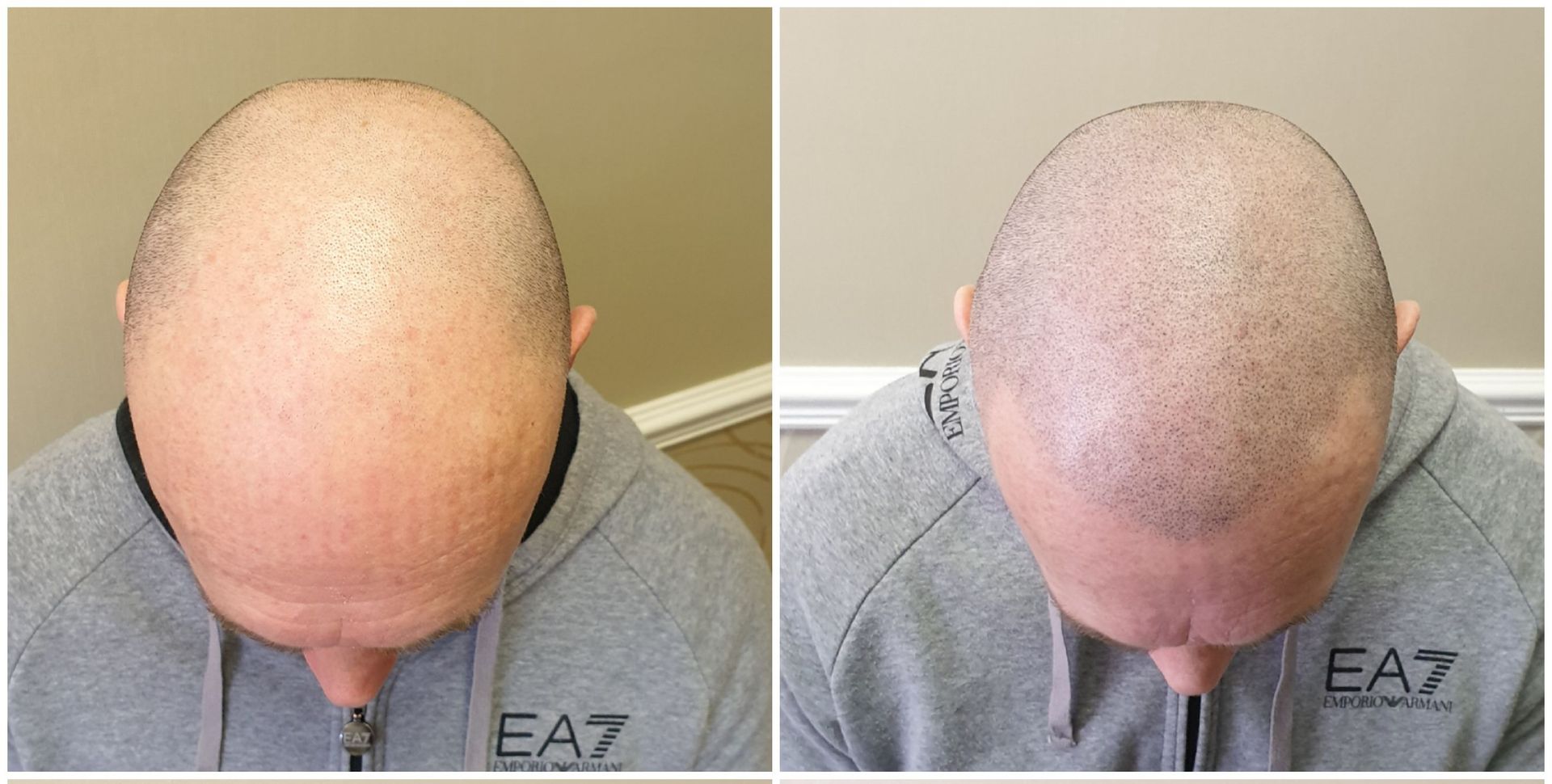 Before and after SMP treatment on men