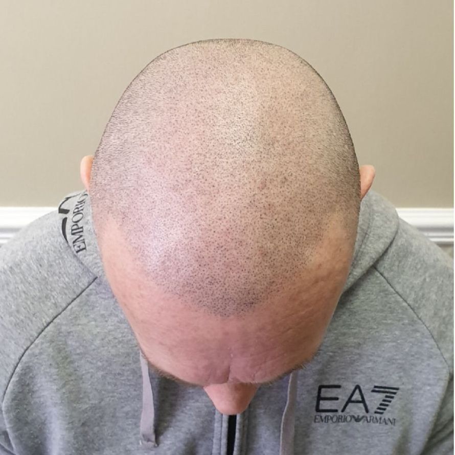 Male pattern baldness treatment