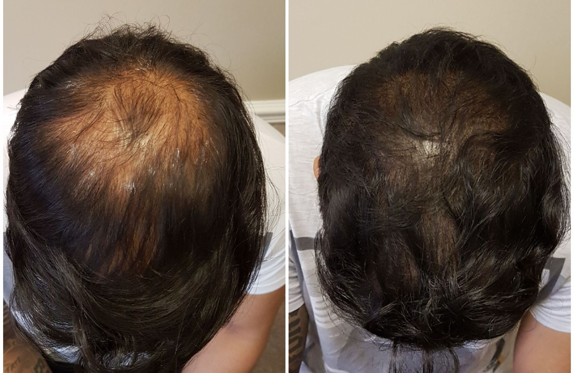 SCALP MICROPIGMENTATION MISCONCEPTIONS ADDRESSED
