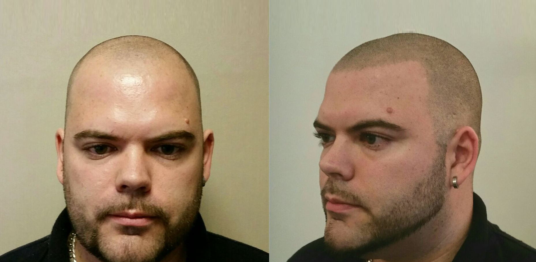 Your Hair Clinic Mens SMP Result