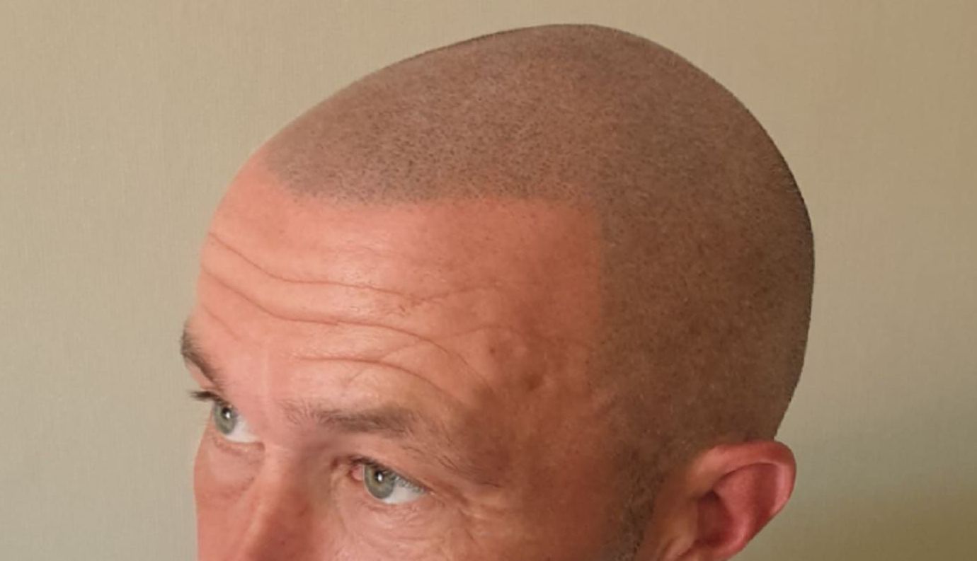 WHAT SHOULD MEN KNOW ABOUT SCALP MICRO-PIGMENTATION?