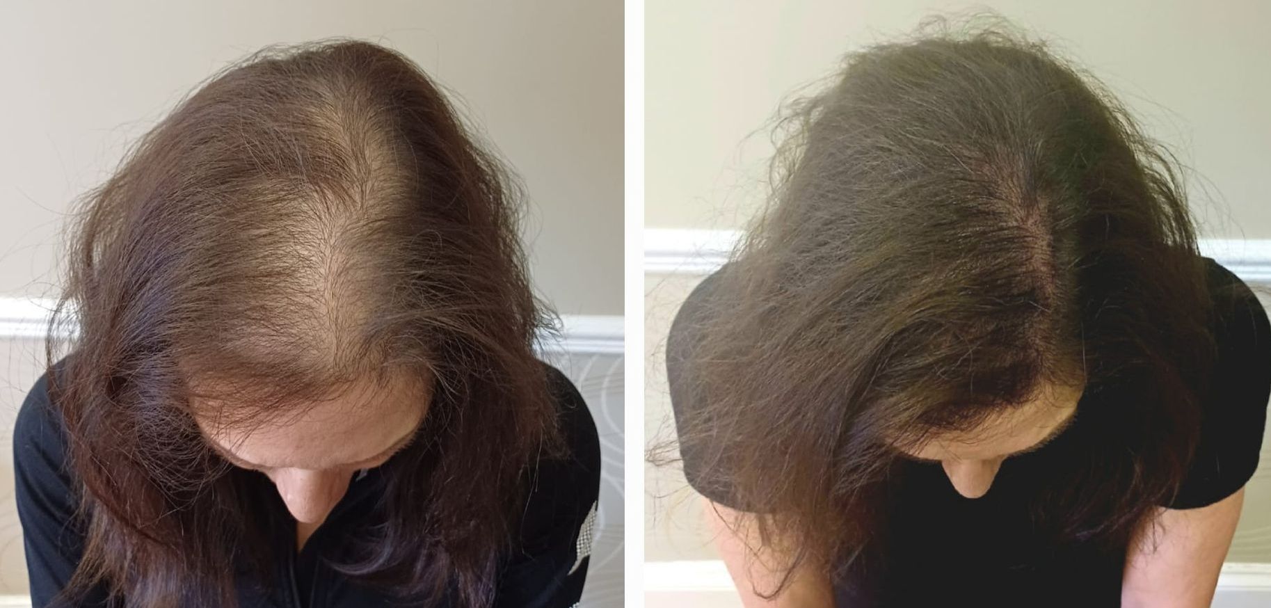 WHAT ARE THE SIGNS THAT WOMEN SHOULD CONSIDER SCALP MICROPIGMENTATION?