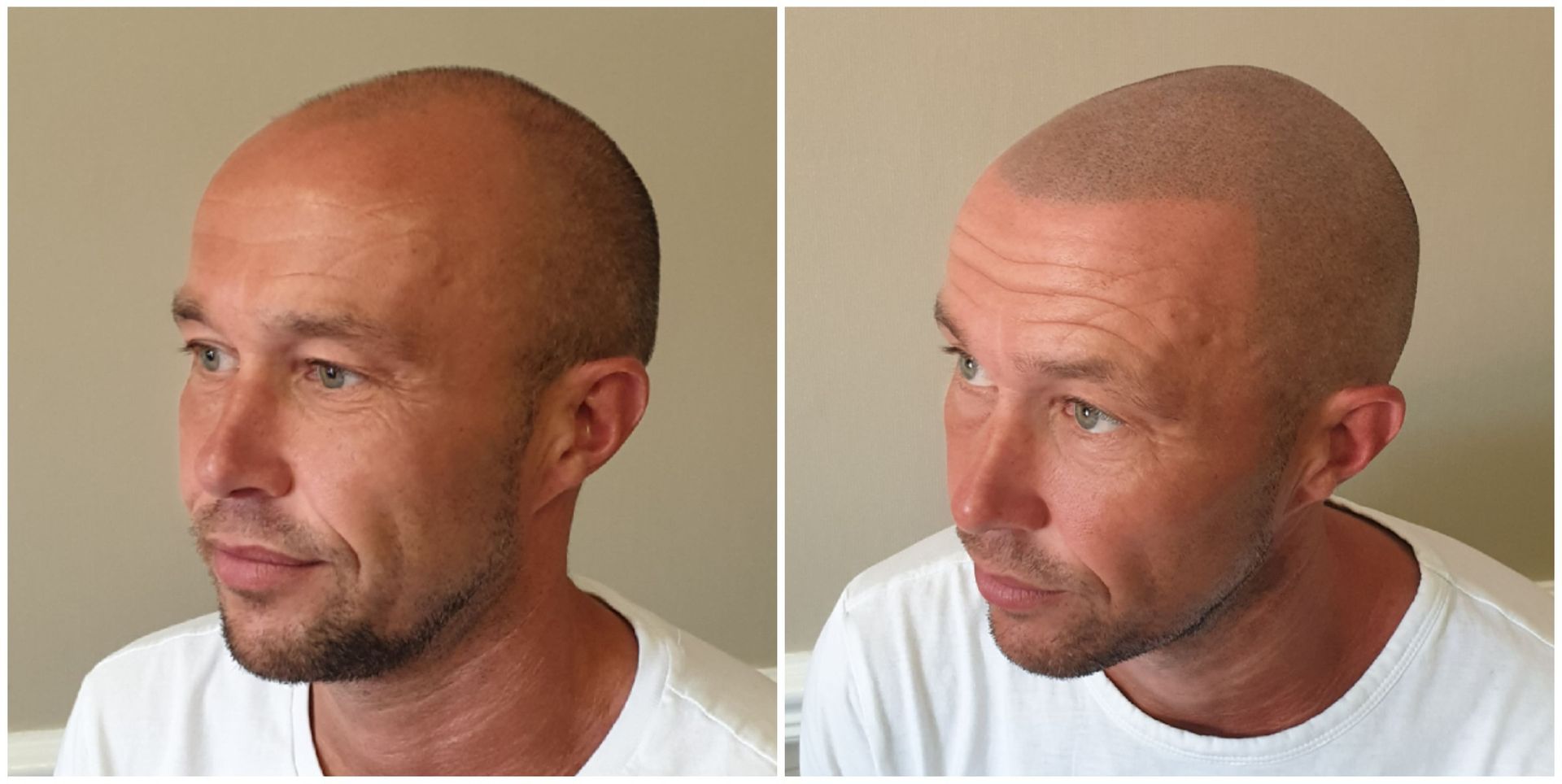 Scalp micropigmentation before and after