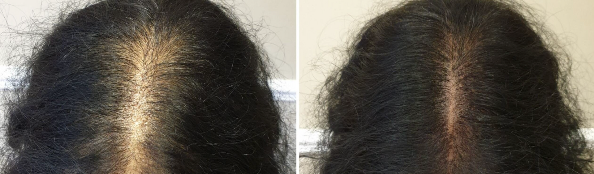 Women SMP for thinning hair