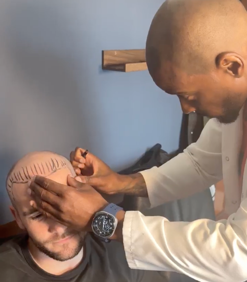 SMP for Thinning, Receding or Shaved Hair