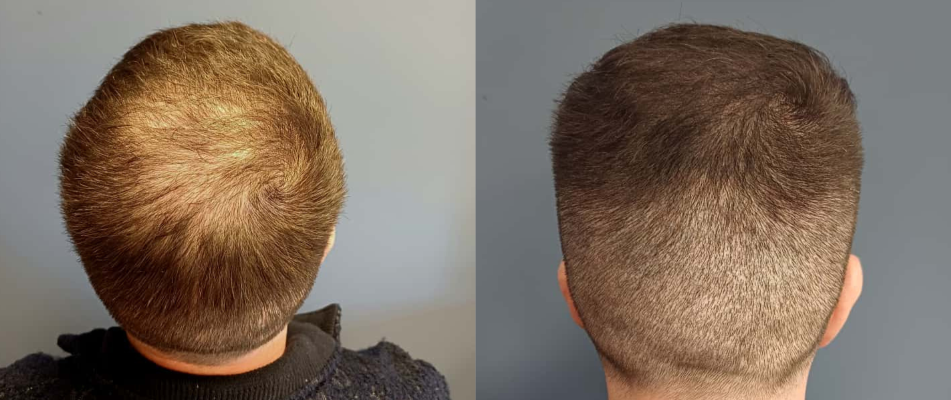 SMP post hair transplant men