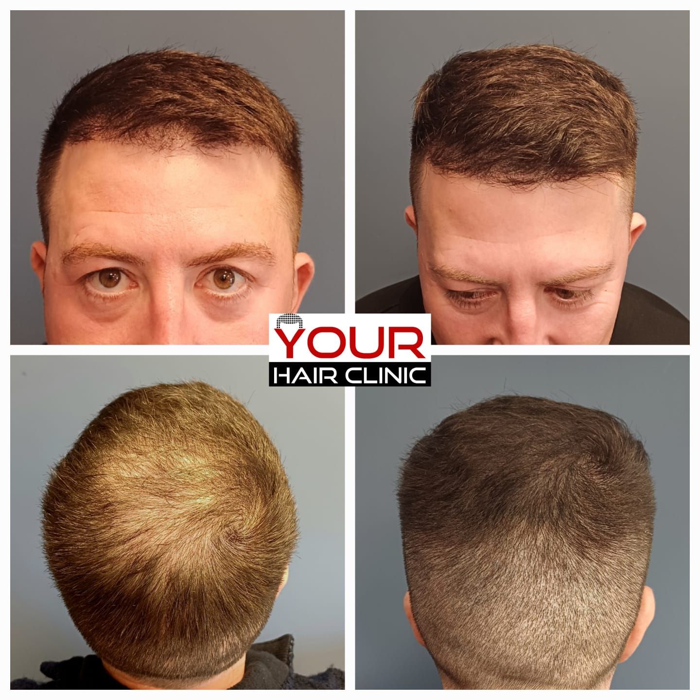 SMP with Hair Transplant Men