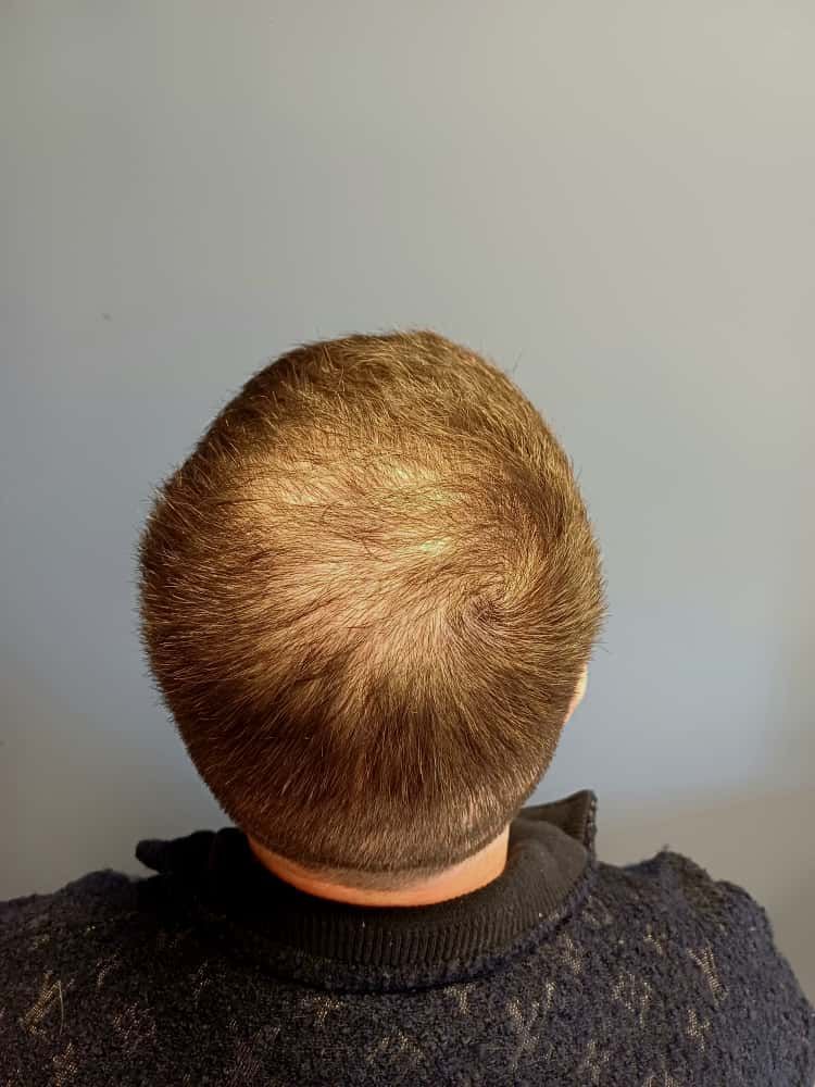 smp with hair transplant results - before and after