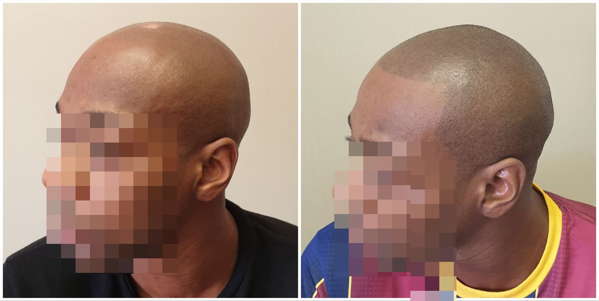 SMP  hairline Before and After Results