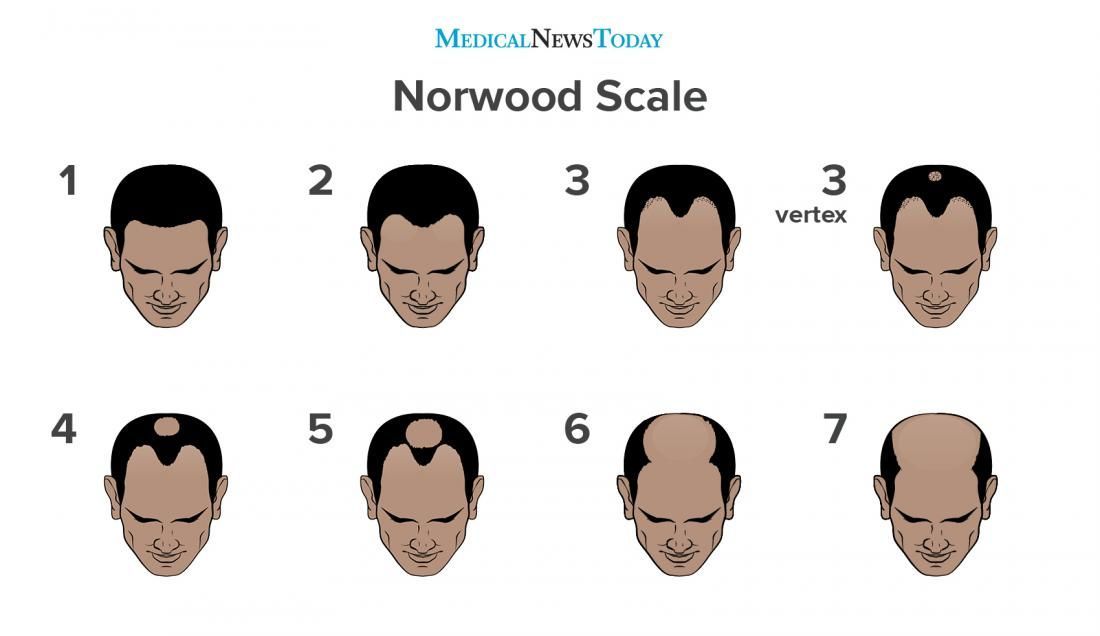 Norwood Scales Hair Loss Infographic - Medical News Today