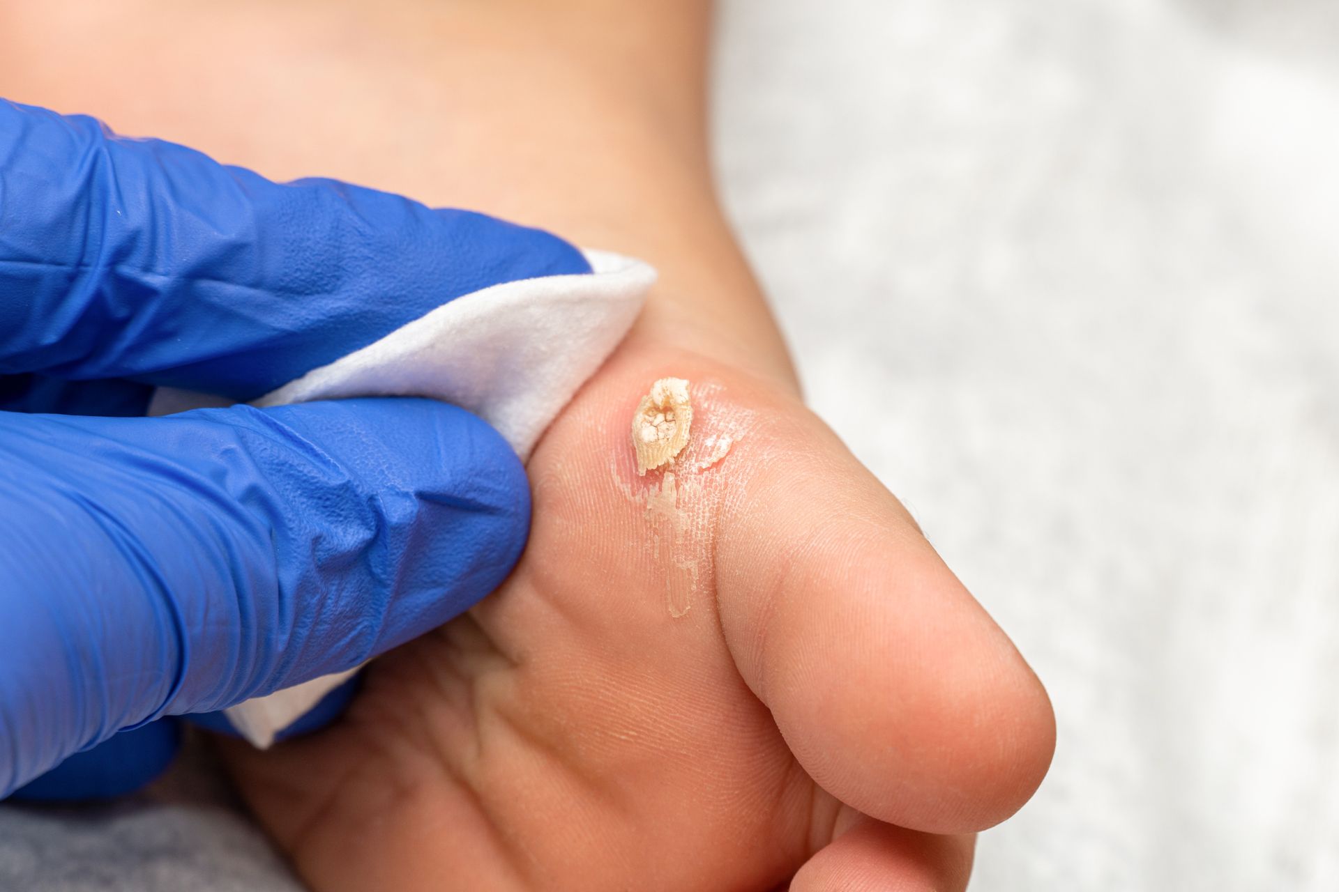 A person is cleaning a wart on their foot with a cotton swab.
