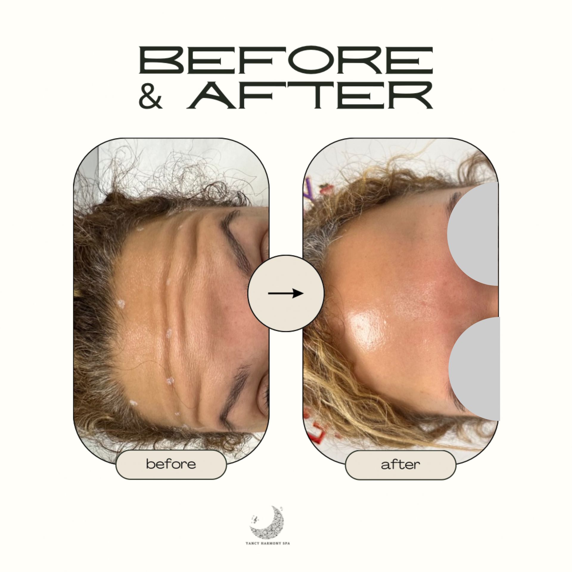 A before and after photo of a woman 's forehead