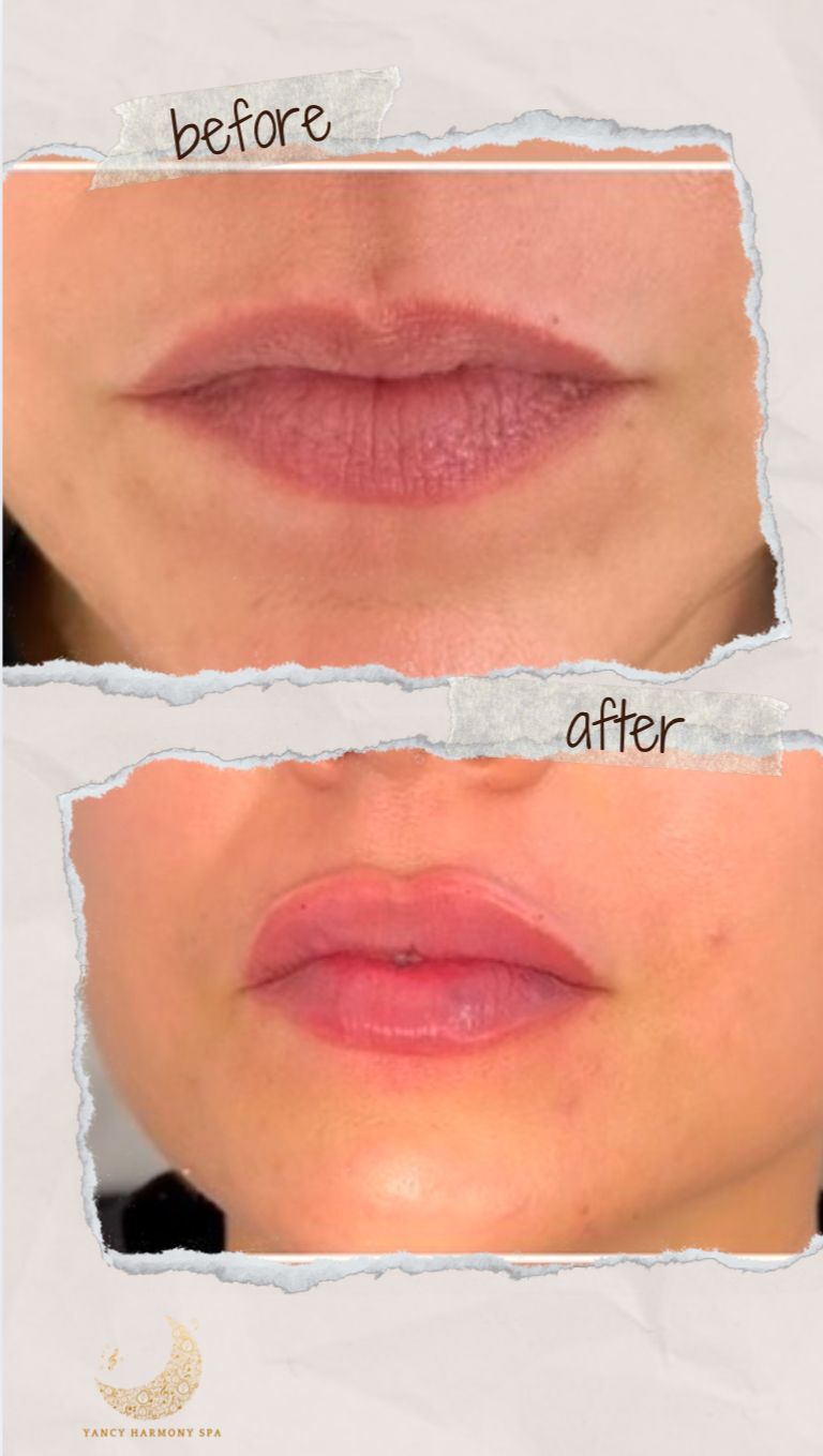 A before and after photo of a woman 's lips.