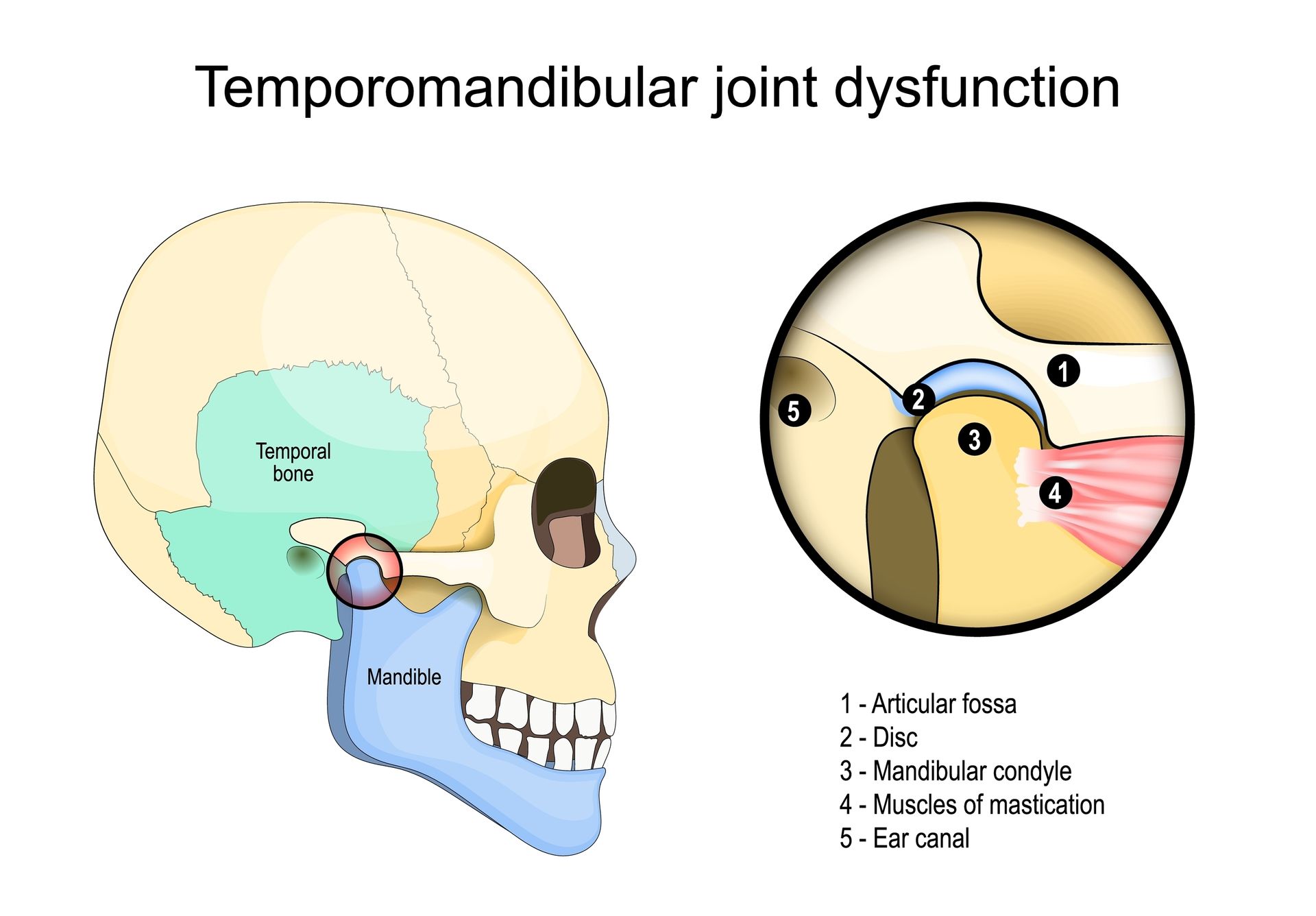 Diagram illustrating temporomandibular joint dysfunction, showing a skull with a highlighted jaw joint and an enlarged view.