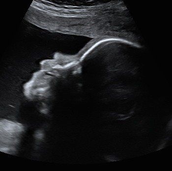 A black and white ultrasound of a baby in the womb.