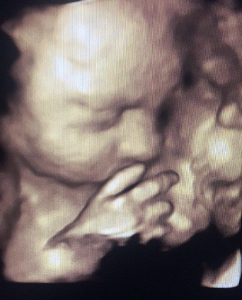 An ultrasound of a baby 's face and hands