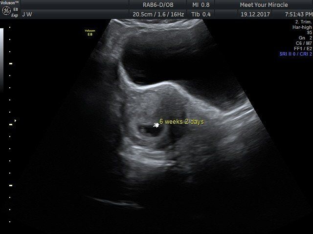 A black and white ultrasound of a baby in the womb