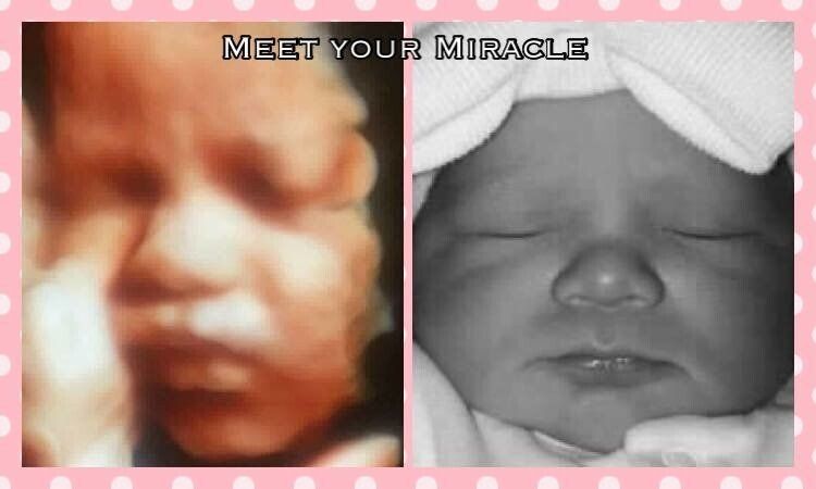 A picture of a baby with the words meet your miracle on it